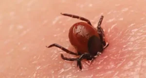 Tick Fever – Dr Dick Stockley